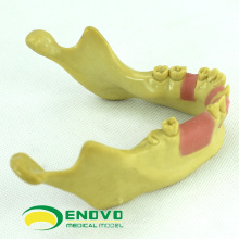 VENDA 12619 implante dentário faltando modelo de treinamento de dentes